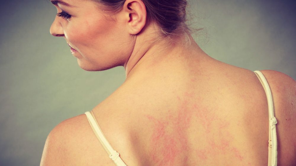 “a Dermatite Atópica é Mais Do Que Uma Doença De Pele” 7474